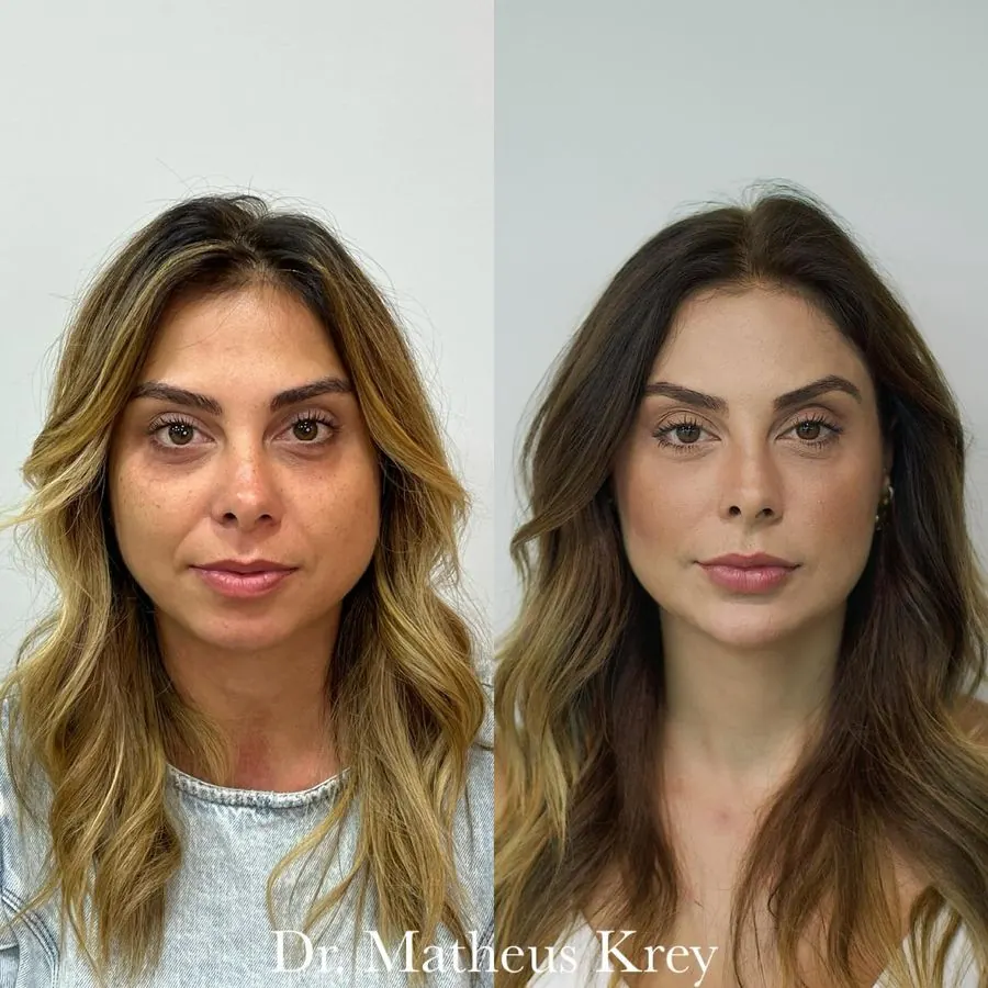 Antes e depois: harmonização facial