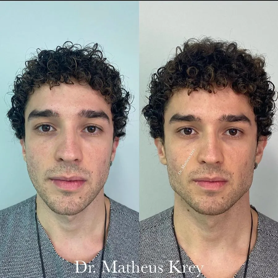 Antes e depois: harmonização masculina