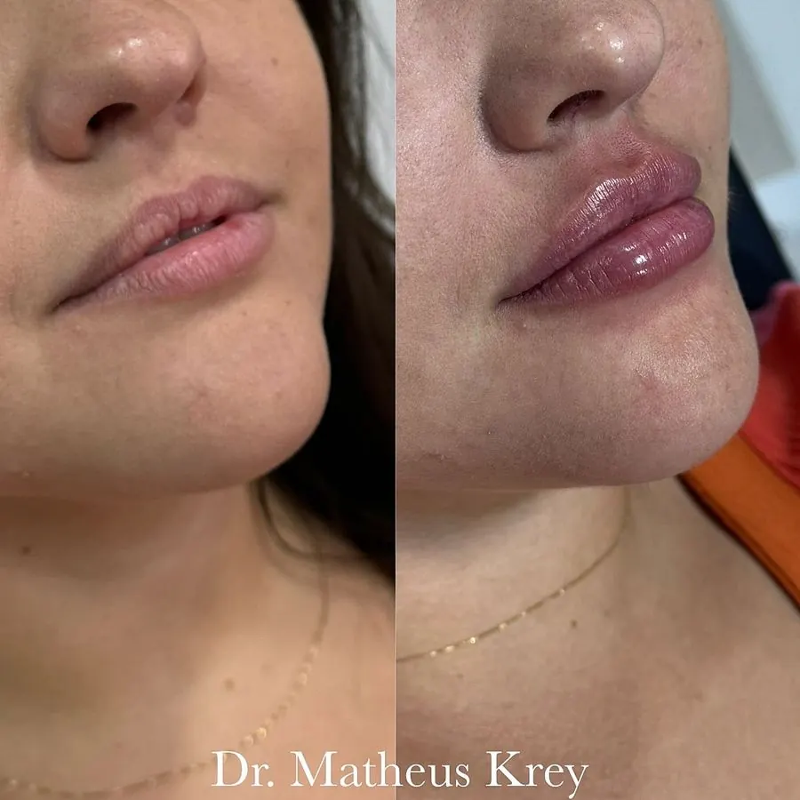 Antes e depois: preenchimento labial