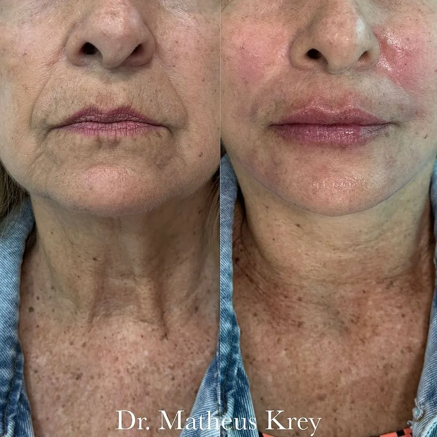 Antes e depois: rejuvenescimento dos lábios
