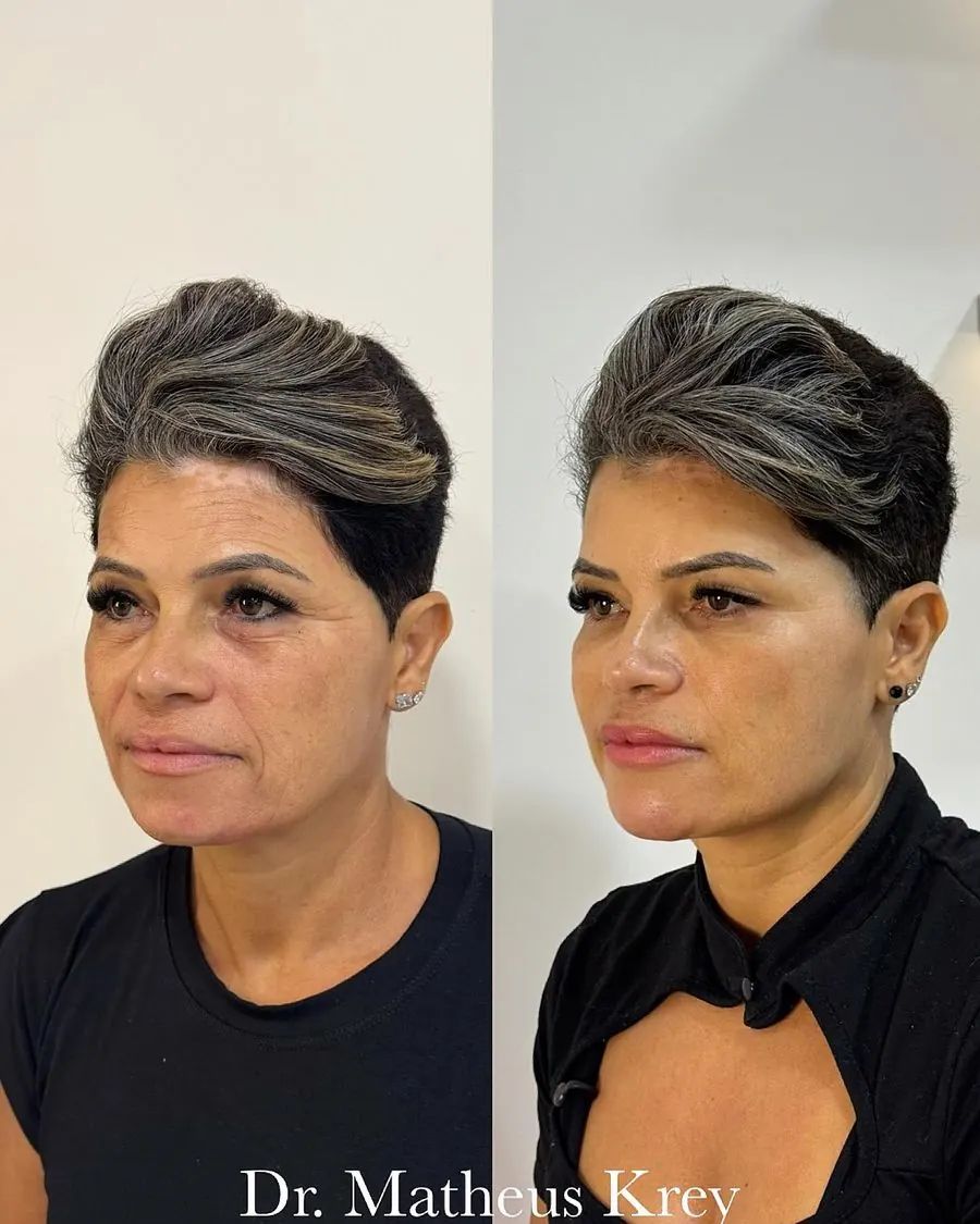 Antes e depois: rejuvenescimento facial